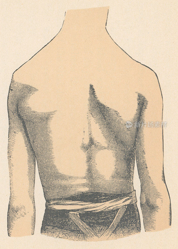 伴有副神经紊乱的年轻成年男子的医学插图- 19世纪